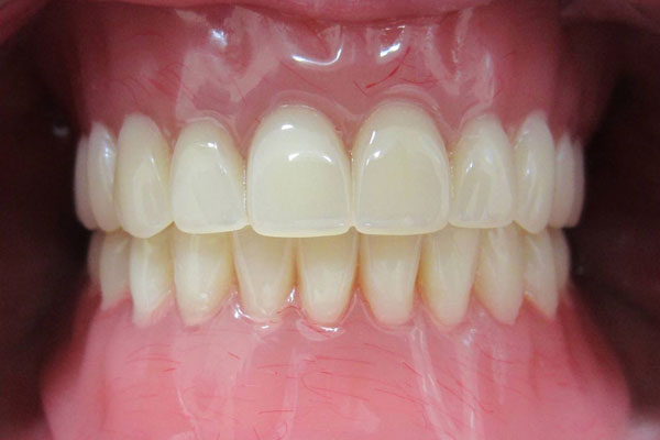 СТОМАТОЛОГИ РЯЗГМУ ДАРЯТ НОВУЮ УЛЫБКУ ПАЦИЕНТАМ ПОСЛЕ ОНКОЛОГИЧЕСКИХ ЗАБОЛЕВАНИЙ И ТРАВМ ЧЕЛЮСТИ