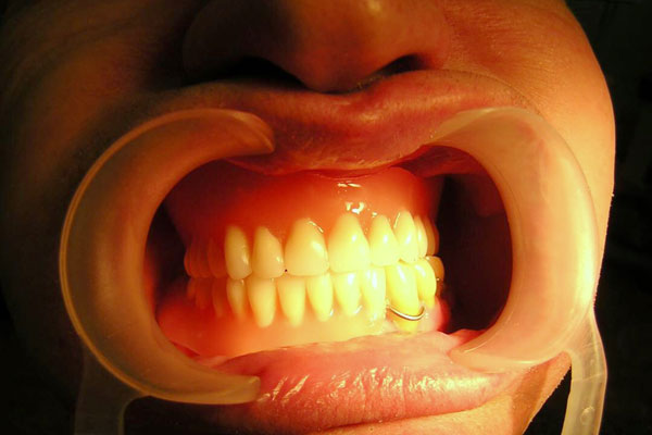 ЗУБНЫЕ ПРОТЕЗЫ, НЕ НАРУШАЮЩИЕ ДИКЦИЮ, ЗАПАТЕНТОВАЛИ УЧЕНЫЕ РЯЗАНСКОГО МЕДУНИВЕРСИТЕТА