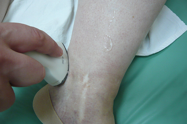 УЧЁНЫЕ РЯЗГМУ ЗАПАТЕНТОВАЛИ НОВЫЙ МЕТОД ДИАГНОСТИКИ ВЕНОЗНОЙ НЕДОСТАТОЧНОСТИ